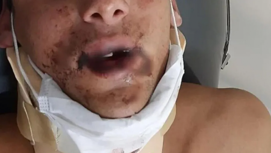 Brutal piñadera entre rugbiers: un joven terminó con la cara desfigurada, sin dientes y pelea por su vida
